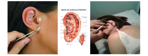 Auriculoterapia